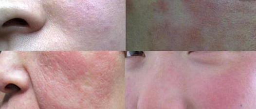 皮肤角质层受损后症状?(艾苛蜜)修复皮肤屏障,增强皮肤免疫力!