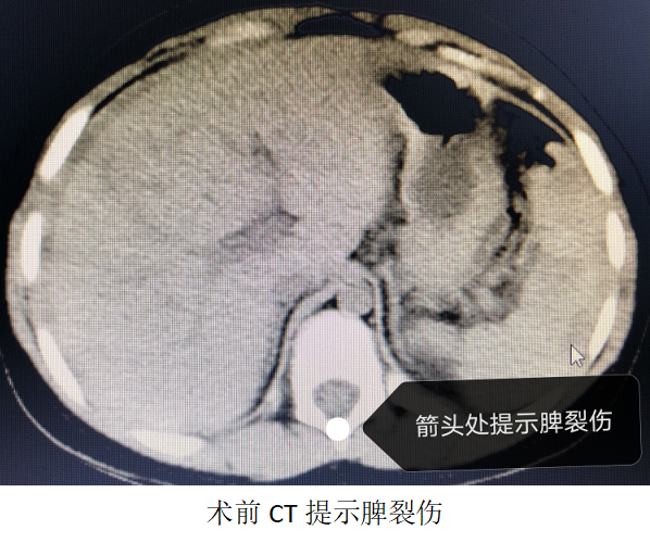 七岁女孩"飞车"致脾破裂出血,介入手术快速止血不开刀