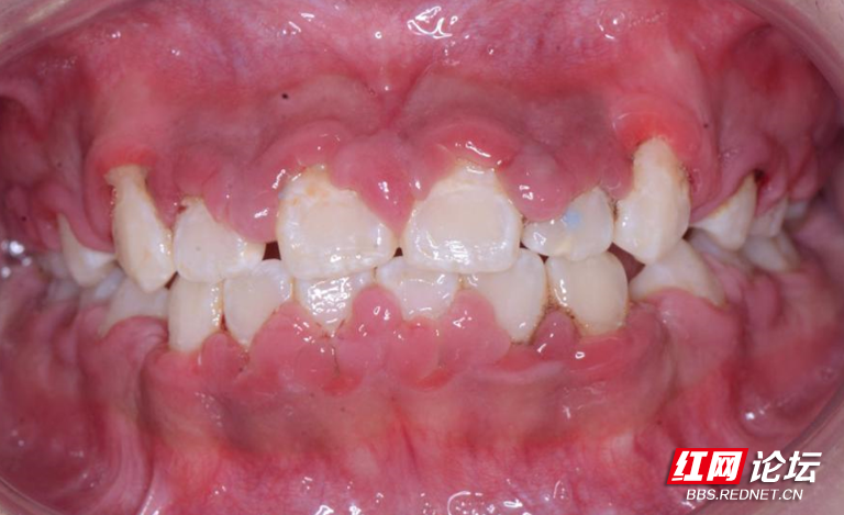 张亚梅医生一看, 整口牙龈肿胀,覆盖牙面至少1/2,牙套也被覆盖,钢丝若