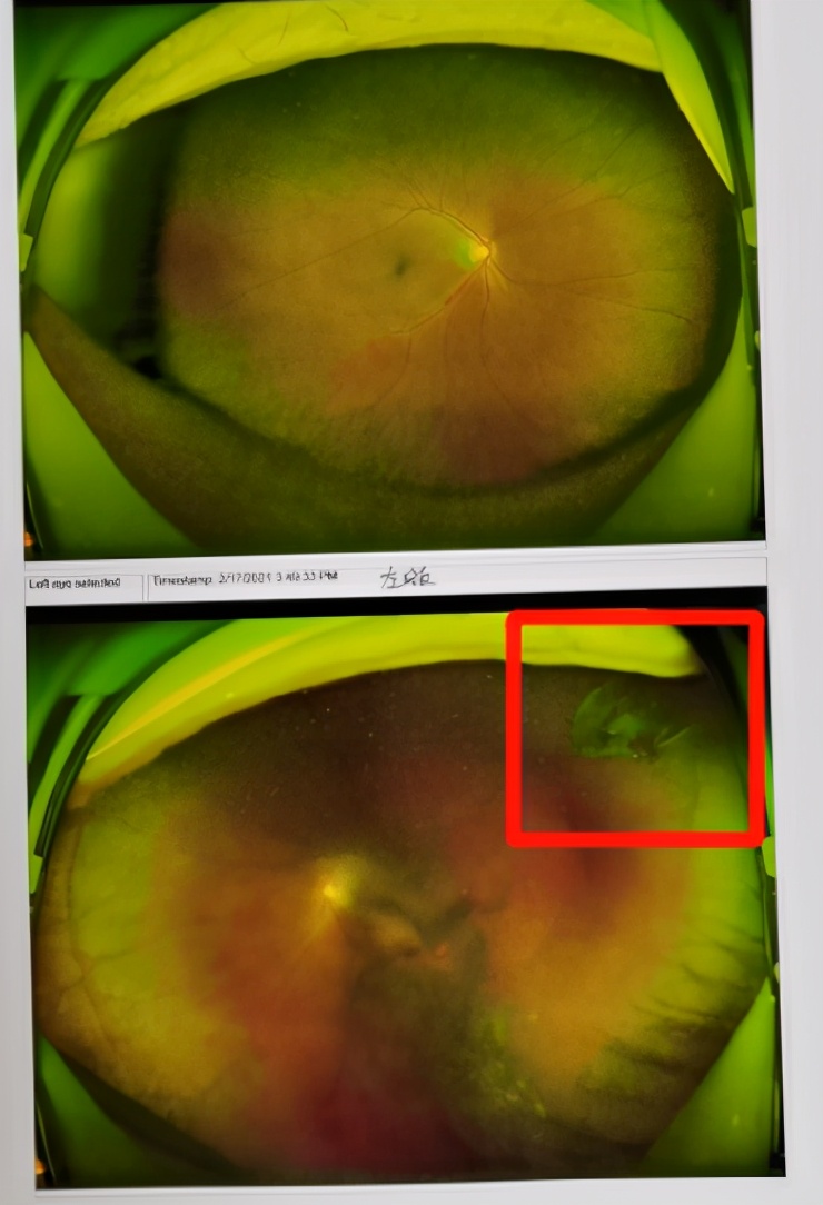 视网膜锯齿缘离断图片图片