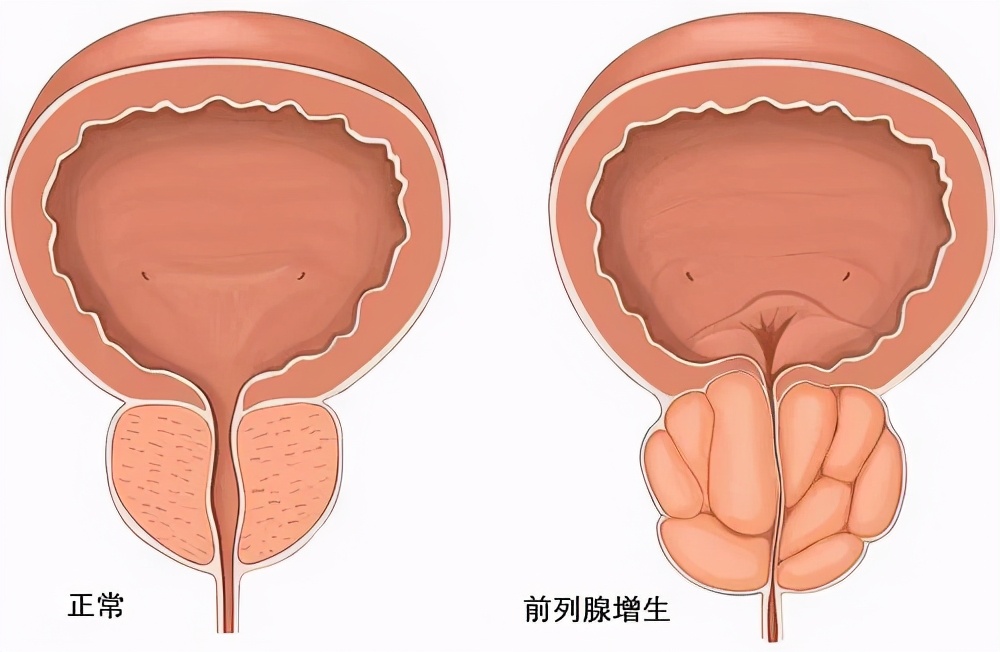 前列腺增生图片症状图片